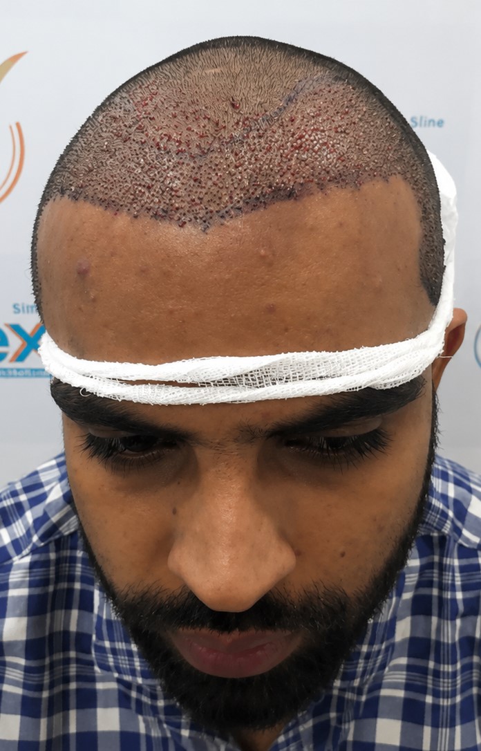 Scalp before hair transplant treatment at Dexa Clinic